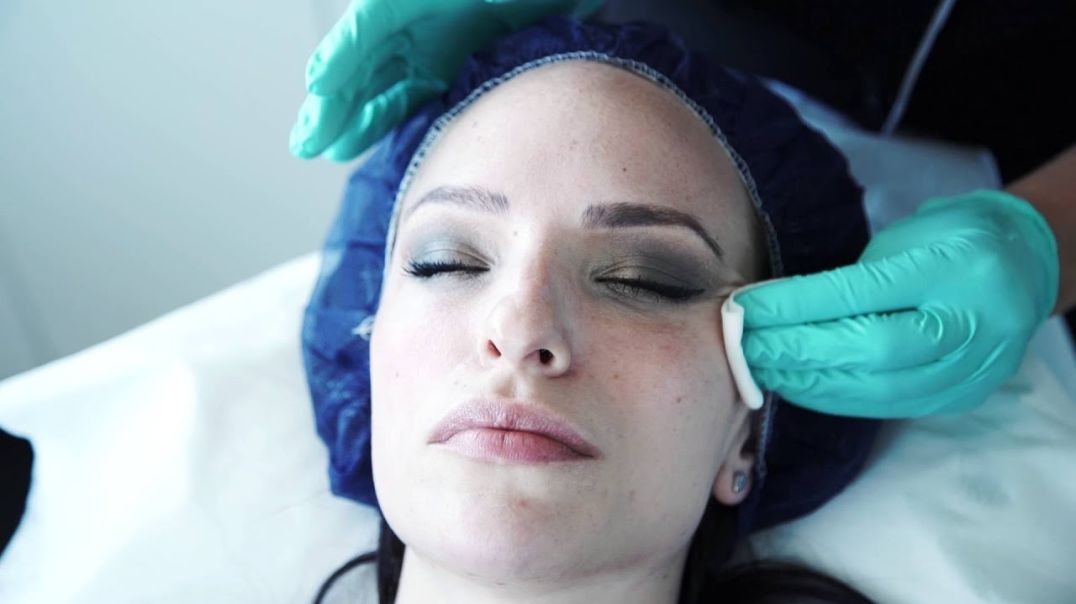 ⁣Chemical Peels - lactic acid peel demonstration