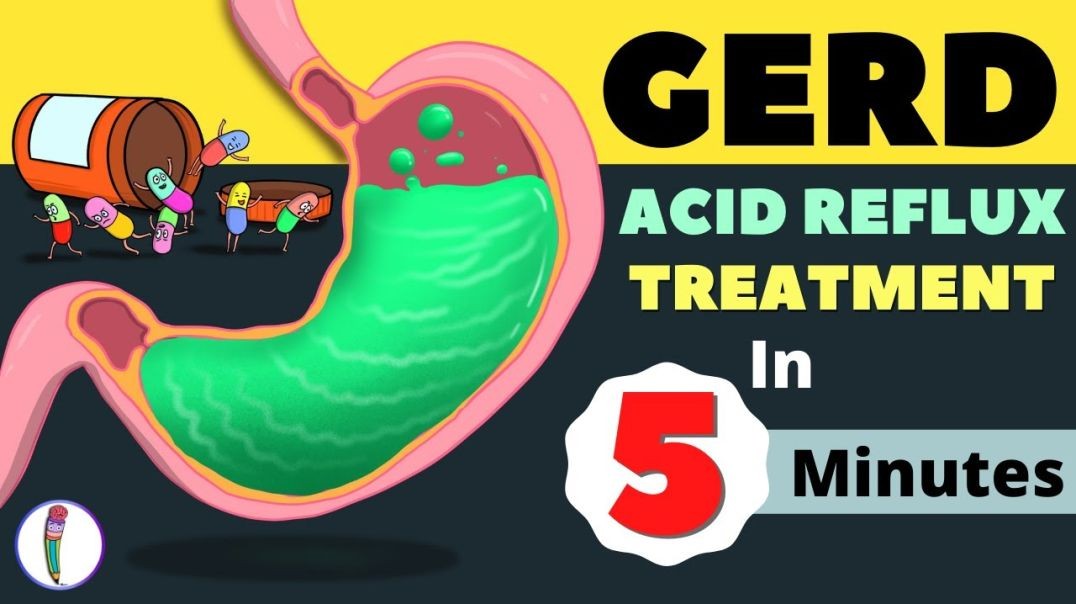 ⁣GERD Treatment _ Acid Reflux Treatment _ Heartburn Treatment - All You Need to Know